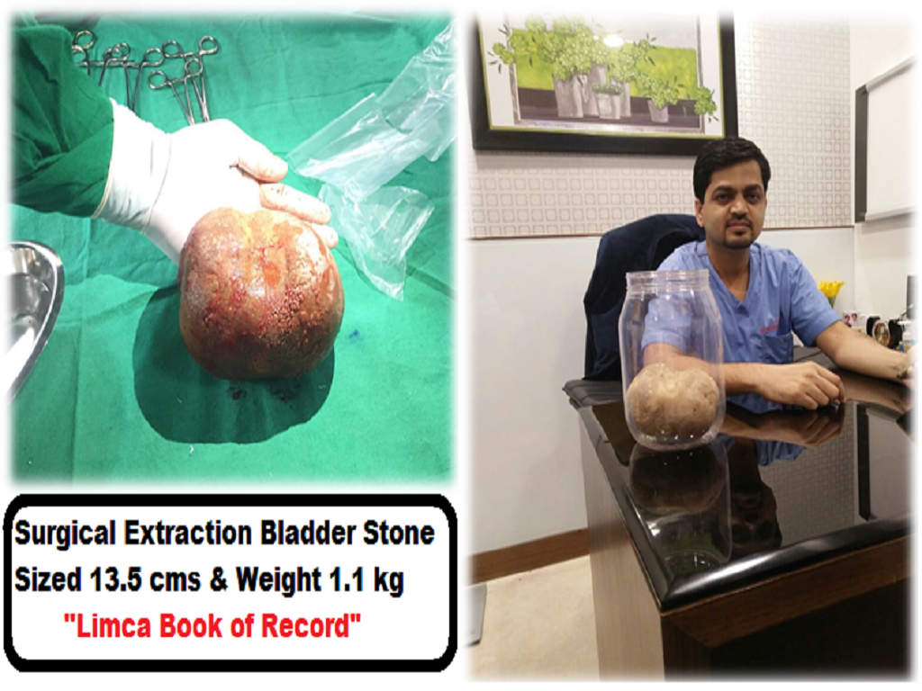 13.5 cms. Weighing 1.1 kg. Stone Removed from Bladder